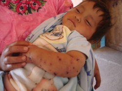 A Mayan baby with a rash on his arm which his parents say is caused by Goldcorp's Marlin mine // Rights Action